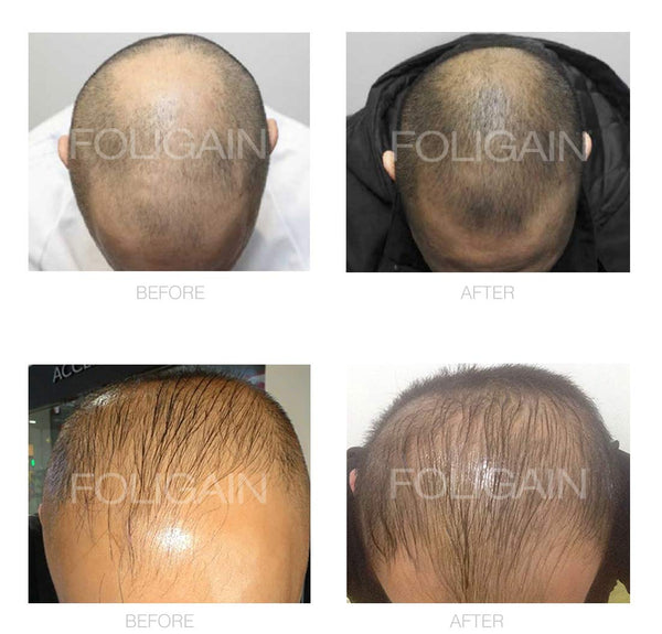 FOLIGAIN Minoxidil 5% Hair Regrowth Foam For Men 6 Month Supply - FOLIGAIN Canada