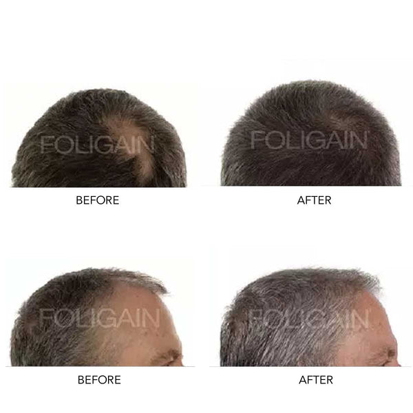 FOLIGAIN Men's Hair Regrowth Kit - FOLIGAIN Canada