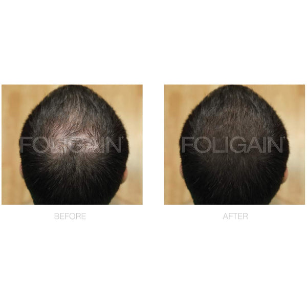 FOLIGAIN Low Alcohol Minoxidil 5% Hair Regrowth Treatment For Men 12 Month Supply - FOLIGAIN Canada